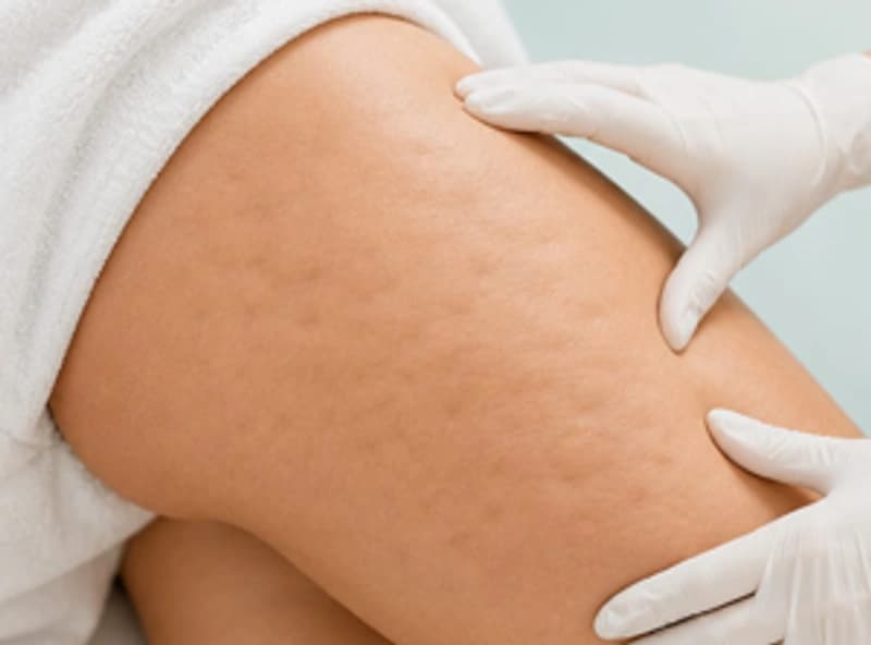 Cellulite