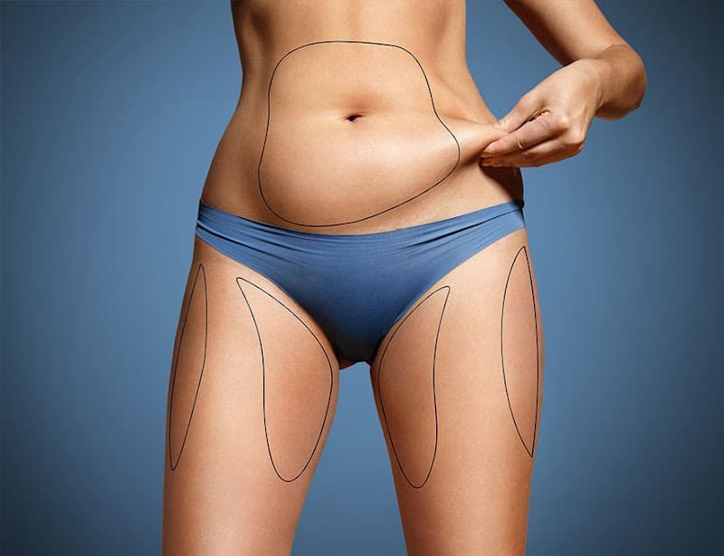 Fat Freezing Brabant - Tilburg