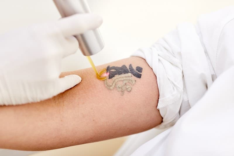 Undo Your Tattoo - Amsterdam